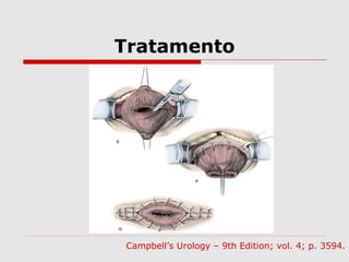 Tratamento
Campbell’s Urology – 9th Edition; vol. 4; p. 3594.
 
