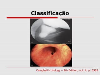Classificação
Campbell’s Urology – 9th Edition; vol. 4; p. 3585.
 