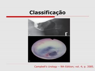 Classificação
Campbell’s Urology – 9th Edition; vol. 4; p. 3585.
 