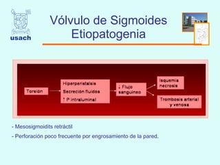 Vólvulo de Sigmoides Etiopatogenia Mesosigmoidits retráctil  Perforación poco frecuente por engrosamiento de la pared .  