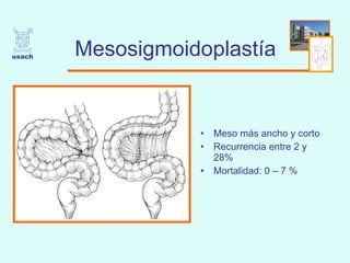 Mesosigmoidoplastía Meso más ancho y corto  Recurrencia entre 2 y 28%  Mortalidad: 0 – 7 % 