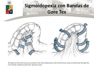 Sigmoidopexia con Bandas de
Gore Tex
 