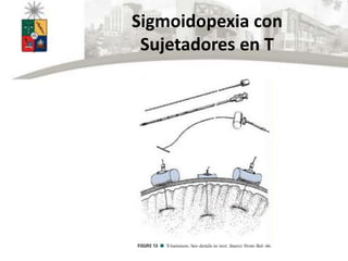 Sigmoidopexia con
Sujetadores en T
 