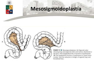 Mesosigmoidoplastía
 