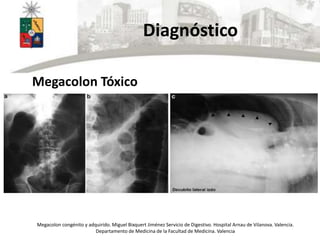 Diagnóstico
Megacolon Tóxico
Megacolon congénito y adquirido. Miguel Bixquert Jiménez Servicio de Digestivo. Hospital Arnau de Vilanova. Valencia.
Departamento de Medicina de la Facultad de Medicina. Valencia
 