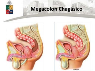 Megacolon Chagásico
 