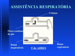 ASSISTÊNCIA RESPIRATÓRIA
Criança

Fluxo contínuo
de gás

Ramo
inspiratório

T de AIRES

Ramo
expiratório

 