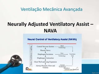 Ventilação Mecânica Avançada
Neurally Adjusted Ventilatory Assist –
NAVA
 