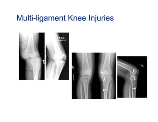 Multi-ligament Knee Injuries
 
