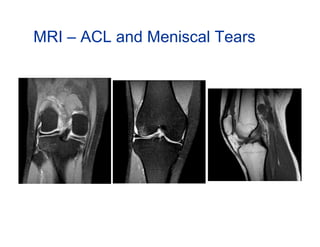 MRI – ACL and Meniscal Tears
 