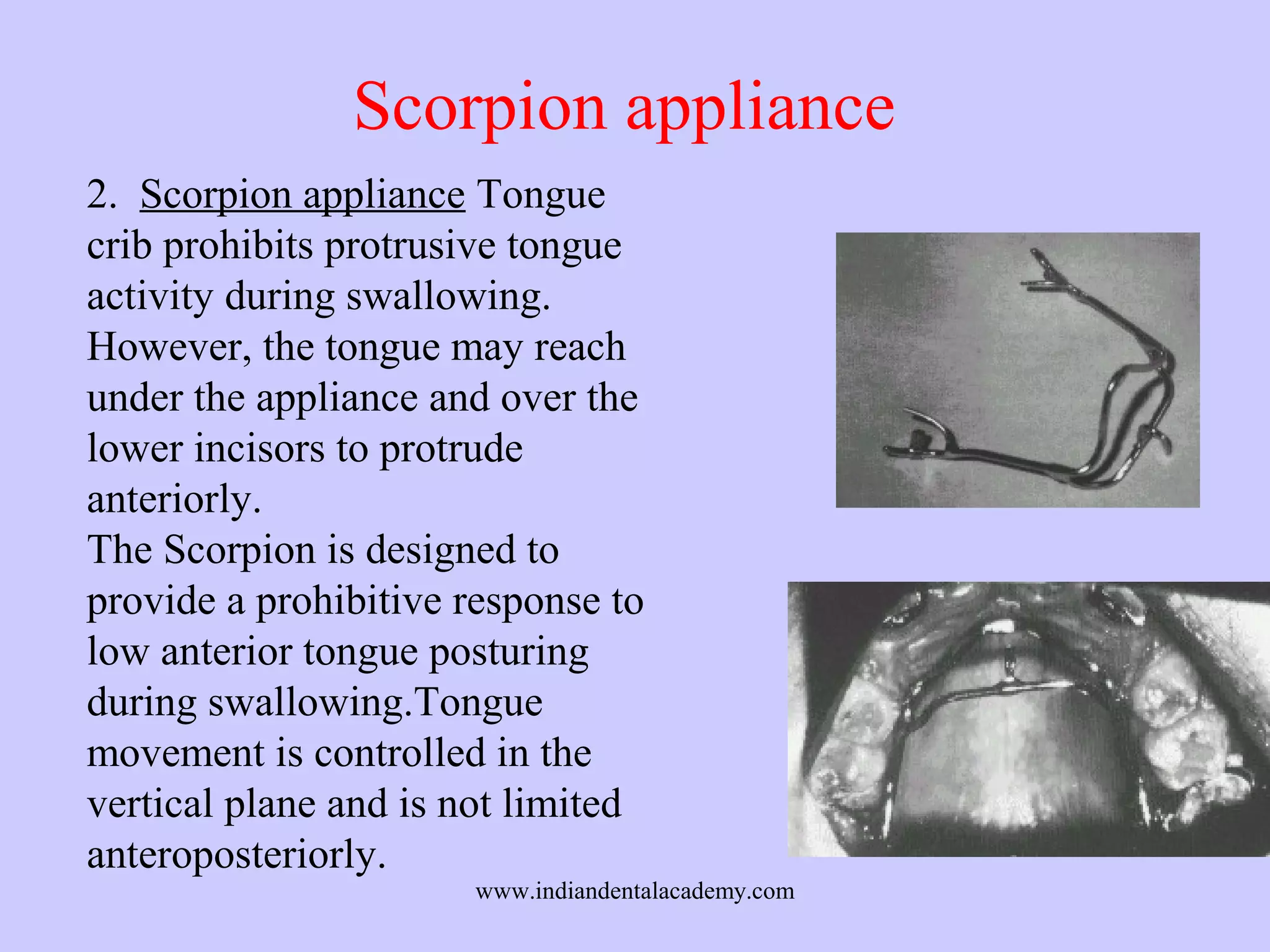 Scorpion appliance
2. Scorpion appliance Tongue
crib prohibits protrusive tongue
activity during swallowing.
However, the tongue may reach
under the appliance and over the
lower incisors to protrude
anteriorly.
The Scorpion is designed to
provide a prohibitive response to
low anterior tongue posturing
during swallowing.Tongue
movement is controlled in the
vertical plane and is not limited
anteroposteriorly.

www.indiandentalacademy.com

 