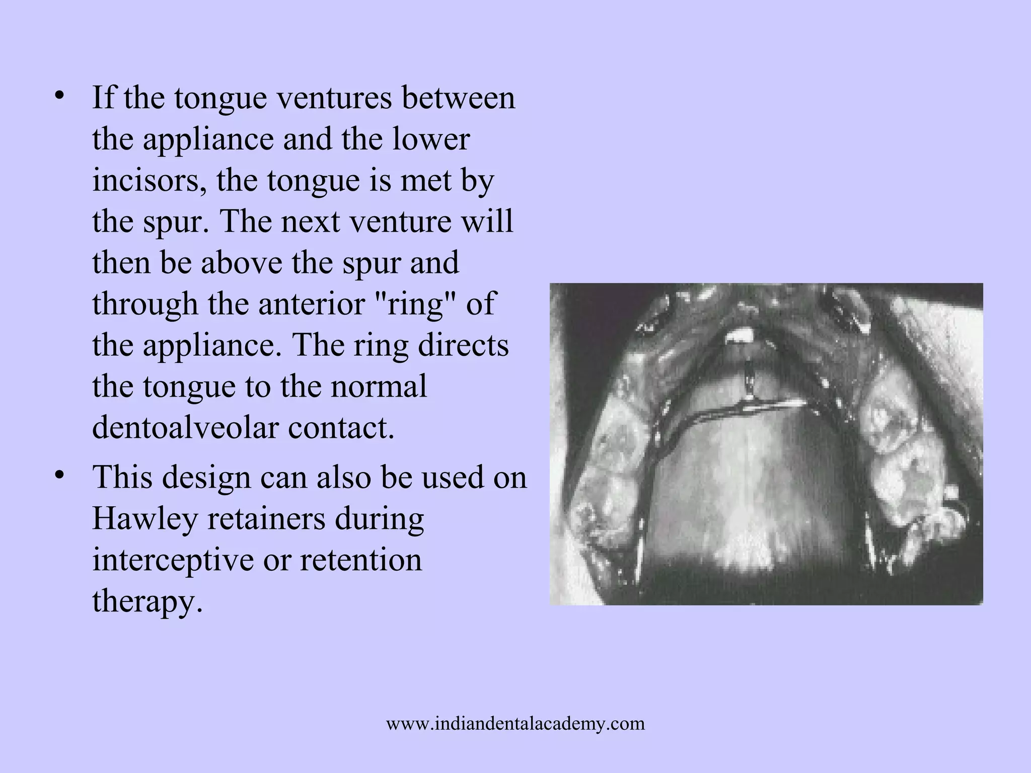 • If the tongue ventures between
the appliance and the lower
incisors, the tongue is met by
the spur. The next venture will
then be above the spur and
through the anterior "ring" of
the appliance. The ring directs
the tongue to the normal
dentoalveolar contact.
• This design can also be used on
Hawley retainers during
interceptive or retention
therapy.

www.indiandentalacademy.com

 