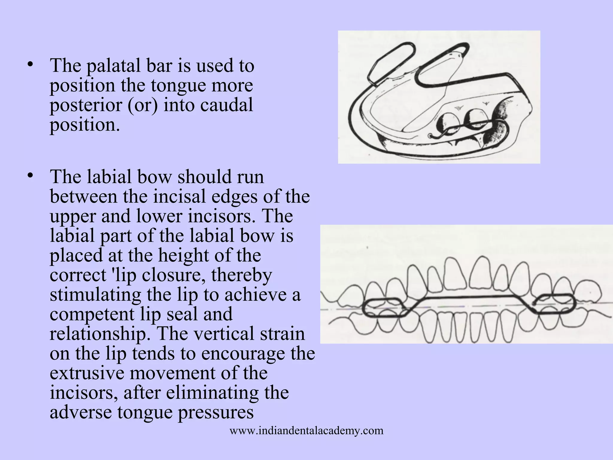 • The palatal bar is used to
position the tongue more
posterior (or) into caudal
position.
• The labial bow should run
between the incisal edges of the
upper and lower incisors. The
labial part of the labial bow is
placed at the height of the
correct 'lip closure, thereby
stimulating the lip to achieve a
competent lip seal and
relationship. The vertical strain
on the lip tends to encourage the
extrusive movement of the
incisors, after eliminating the
adverse tongue pressures
www.indiandentalacademy.com

 