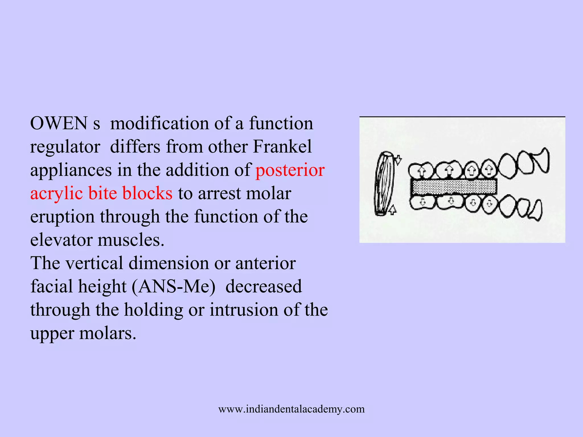 OWEN s modification of a function
regulator differs from other Frankel
appliances in the addition of posterior
acrylic bite blocks to arrest molar
eruption through the function of the
elevator muscles.
The vertical dimension or anterior
facial height (ANS-Me) decreased
through the holding or intrusion of the
upper molars.

www.indiandentalacademy.com

 