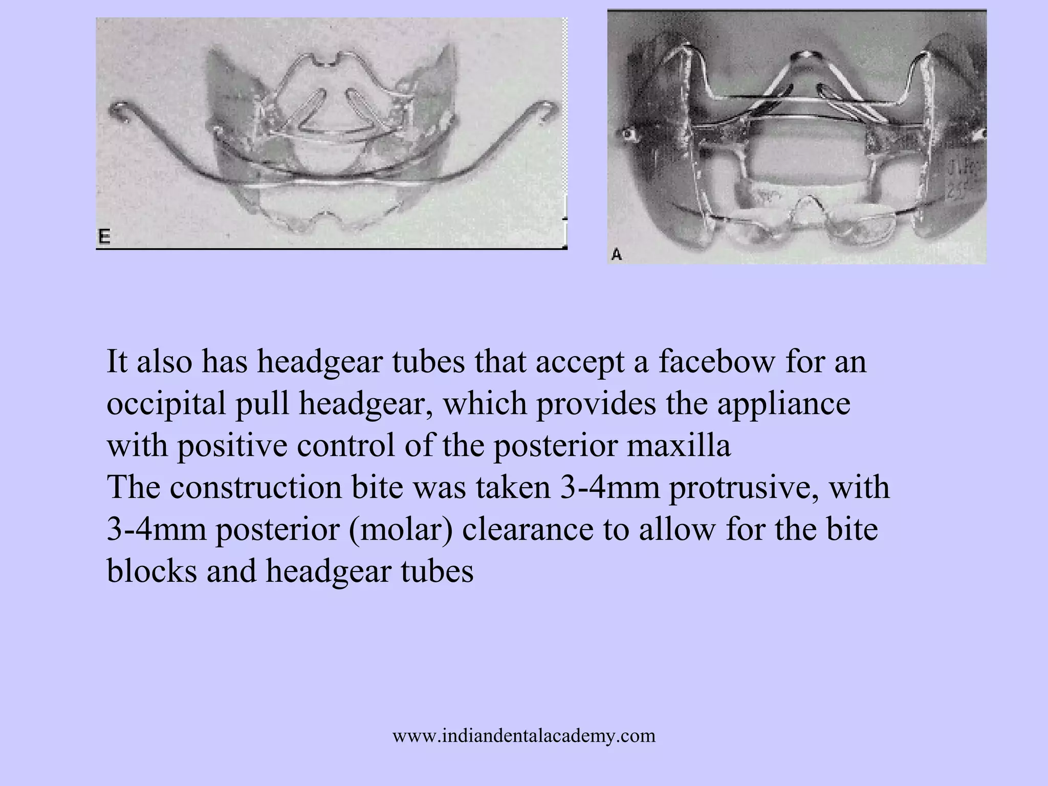 It also has headgear tubes that accept a facebow for an
occipital pull headgear, which provides the appliance
with positive control of the posterior maxilla
The construction bite was taken 3-4mm protrusive, with
3-4mm posterior (molar) clearance to allow for the bite
blocks and headgear tubes

www.indiandentalacademy.com

 