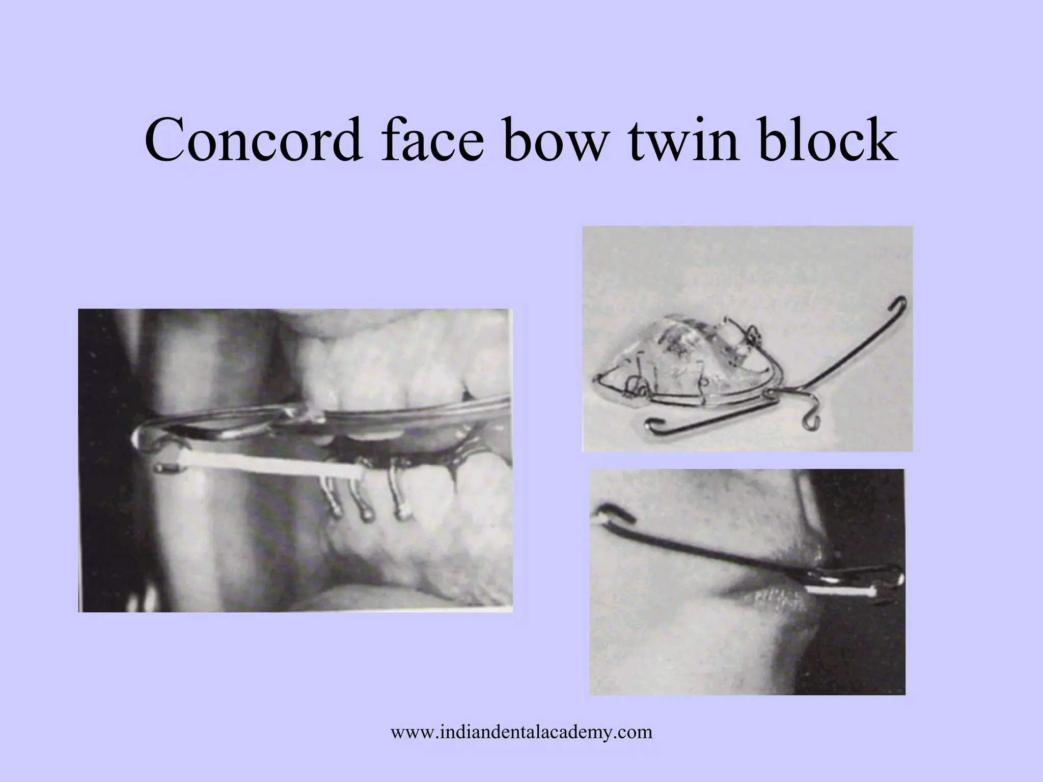 Concord face bow twin block

www.indiandentalacademy.com

 