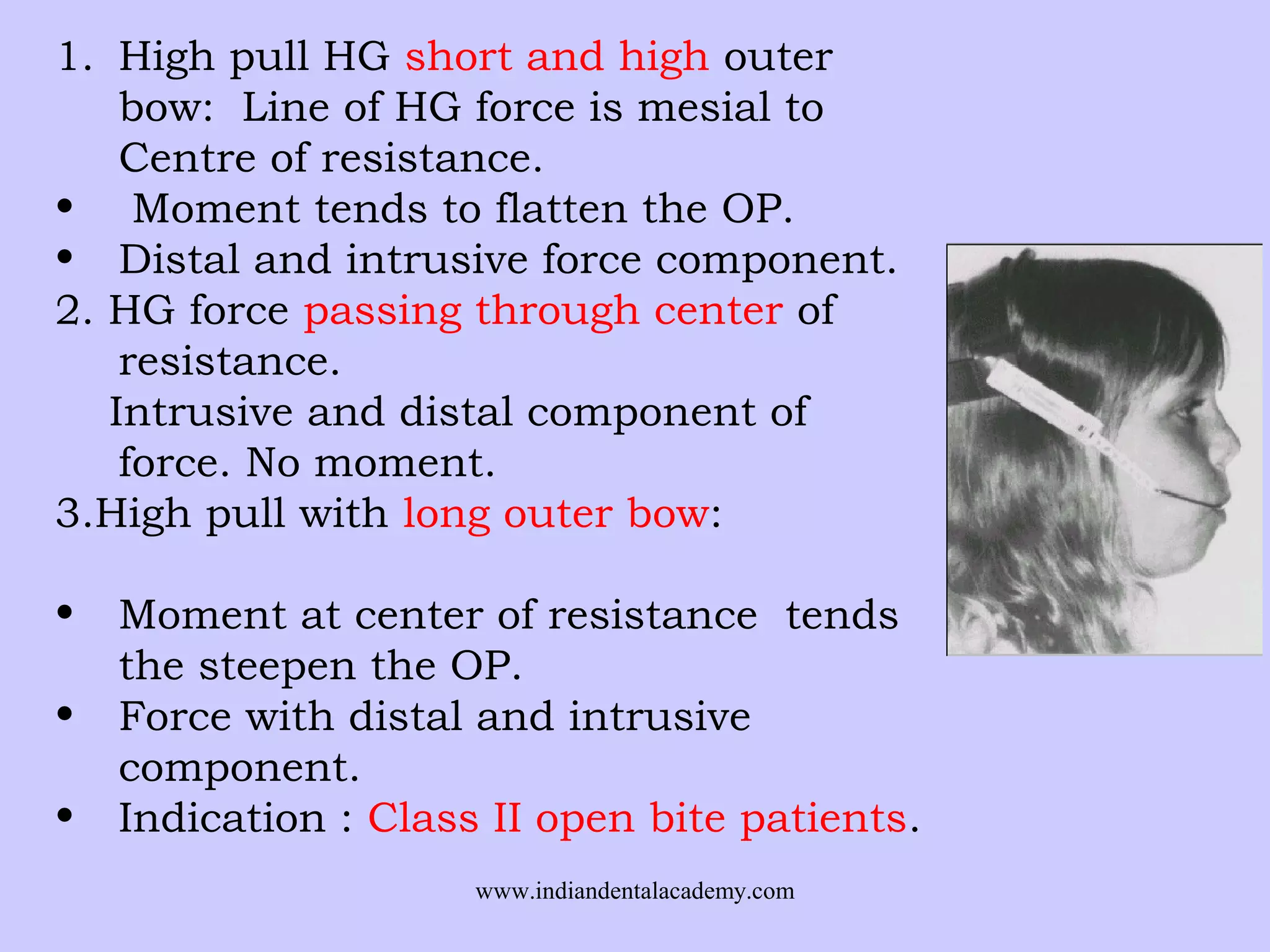 1. High pull HG short and high outer
bow: Line of HG force is mesial to
Centre of resistance.
• Moment tends to flatten the OP.
• Distal and intrusive force component.
2. HG force passing through center of
resistance.
Intrusive and distal component of
force. No moment.
3.High pull with long outer bow:
•
•
•

Moment at center of resistance tends
the steepen the OP.
Force with distal and intrusive
component.
Indication : Class II open bite patients.
www.indiandentalacademy.com

 