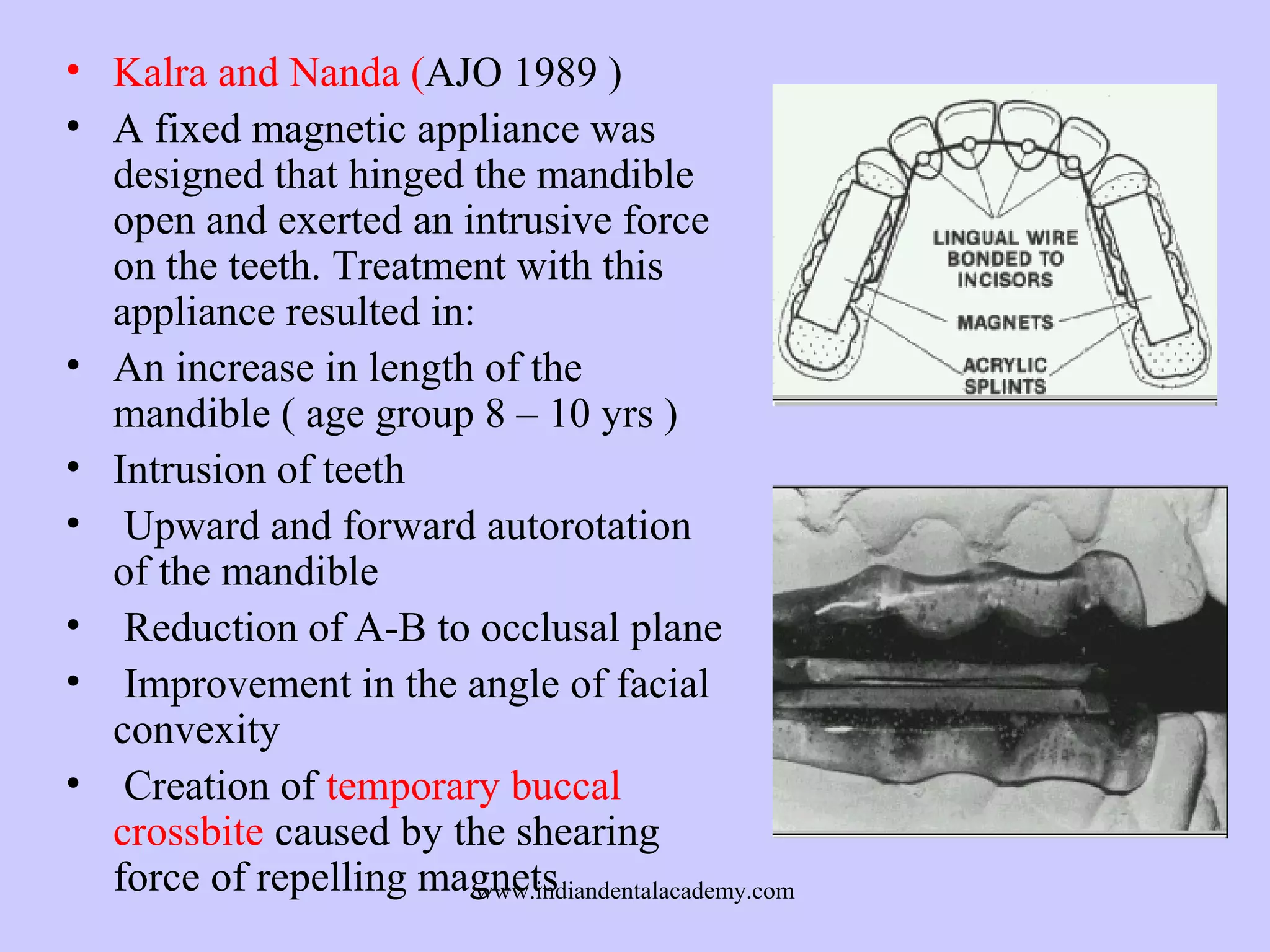 • Kalra and Nanda (AJO 1989 )
• A fixed magnetic appliance was
designed that hinged the mandible
open and exerted an intrusive force
on the teeth. Treatment with this
appliance resulted in:
• An increase in length of the
mandible ( age group 8 – 10 yrs )
• Intrusion of teeth
• Upward and forward autorotation
of the mandible
• Reduction of A-B to occlusal plane
• Improvement in the angle of facial
convexity
• Creation of temporary buccal
crossbite caused by the shearing
force of repelling magnets
www.indiandentalacademy.com

 