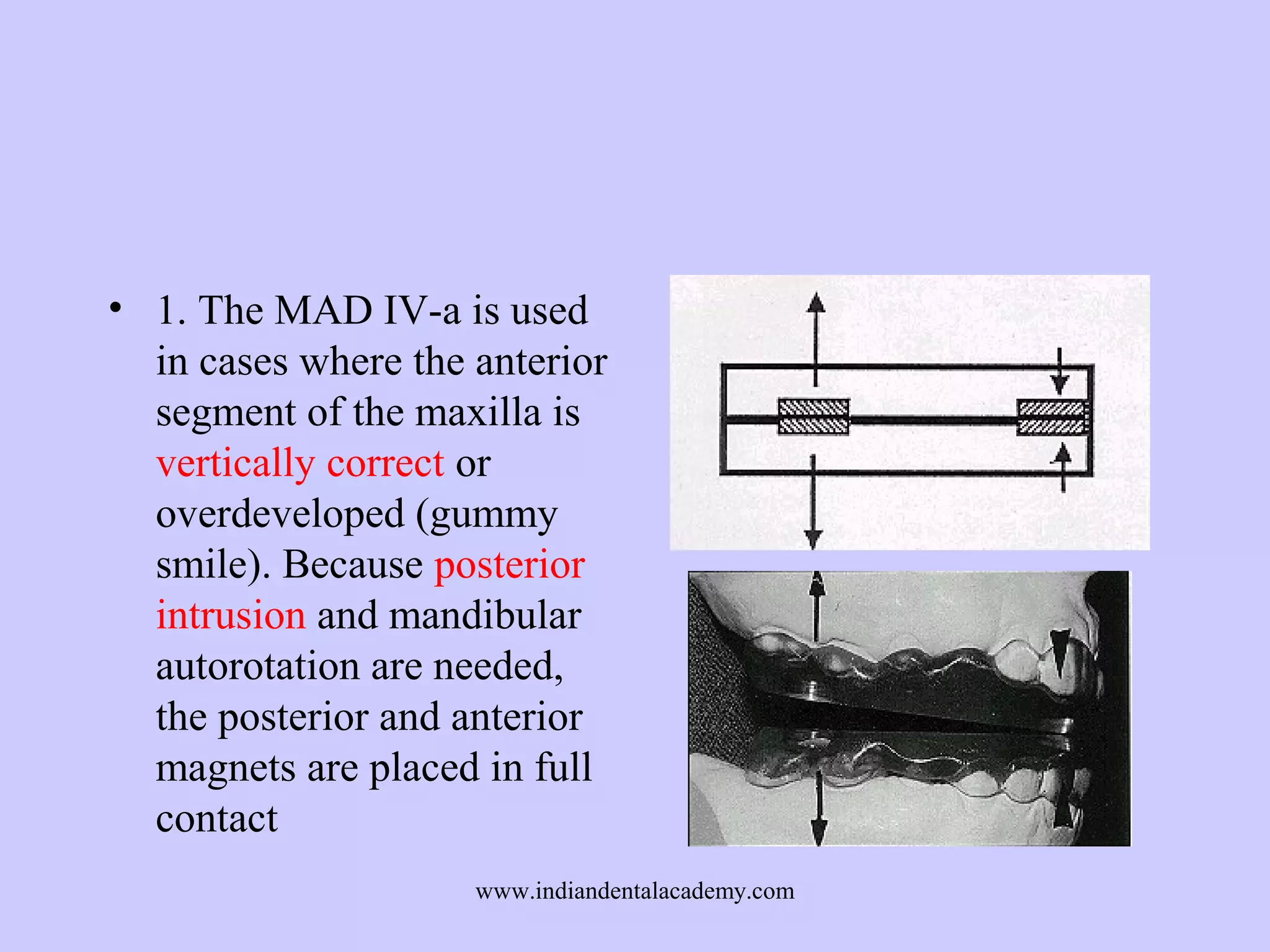 • 1. The MAD IV-a is used
in cases where the anterior
segment of the maxilla is
vertically correct or
overdeveloped (gummy
smile). Because posterior
intrusion and mandibular
autorotation are needed,
the posterior and anterior
magnets are placed in full
contact
www.indiandentalacademy.com

 