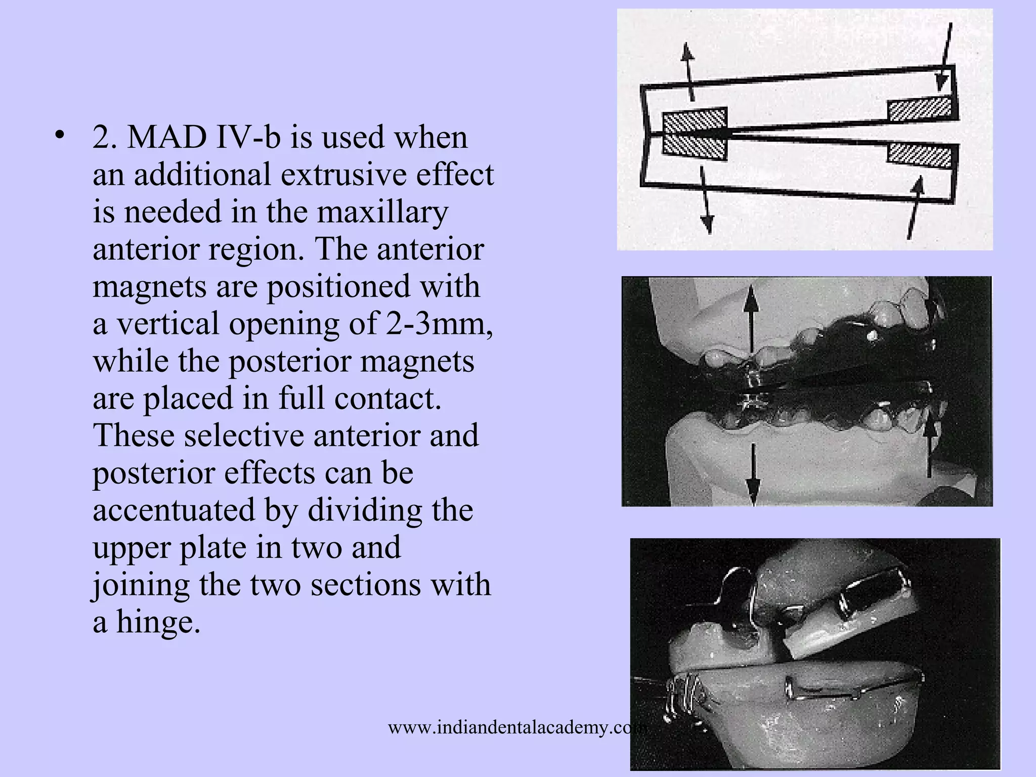 • 2. MAD IV-b is used when
an additional extrusive effect
is needed in the maxillary
anterior region. The anterior
magnets are positioned with
a vertical opening of 2-3mm,
while the posterior magnets
are placed in full contact.
These selective anterior and
posterior effects can be
accentuated by dividing the
upper plate in two and
joining the two sections with
a hinge.
www.indiandentalacademy.com

 