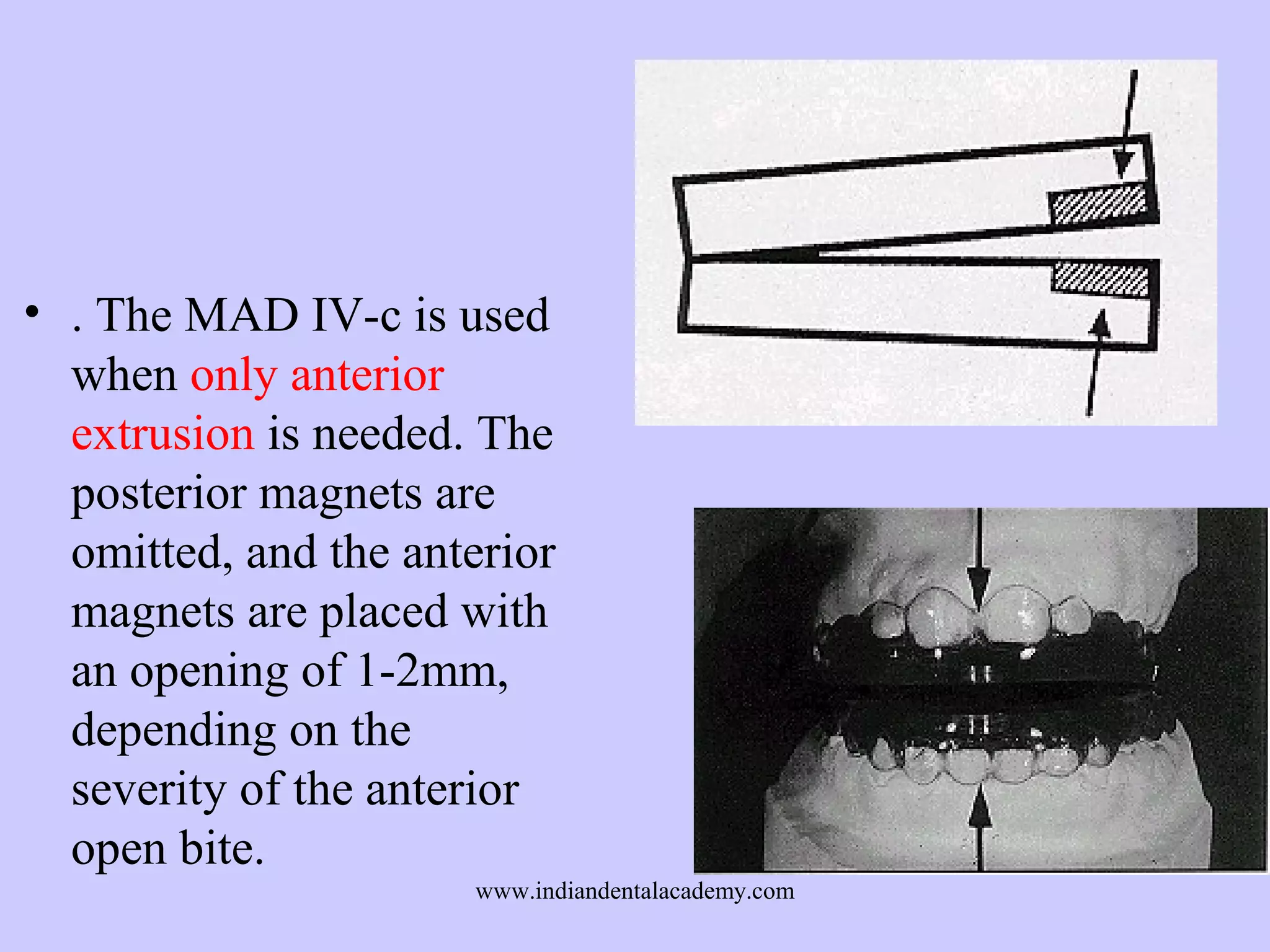 • . The MAD IV-c is used
when only anterior
extrusion is needed. The
posterior magnets are
omitted, and the anterior
magnets are placed with
an opening of 1-2mm,
depending on the
severity of the anterior
open bite.
www.indiandentalacademy.com

 