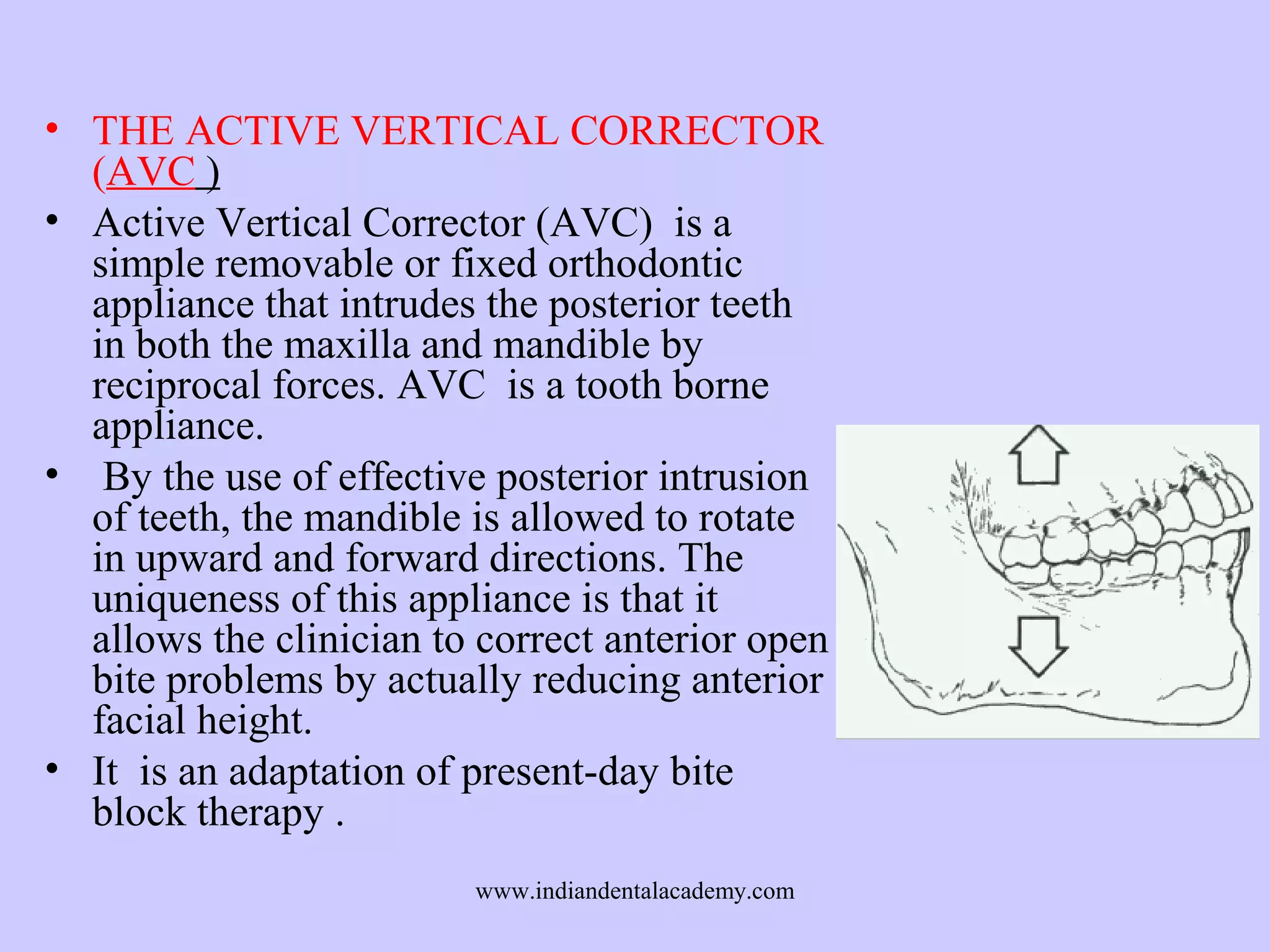 • THE ACTIVE VERTICAL CORRECTOR
(AVC )
• Active Vertical Corrector (AVC) is a
simple removable or fixed orthodontic
appliance that intrudes the posterior teeth
in both the maxilla and mandible by
reciprocal forces. AVC is a tooth borne
appliance.
• By the use of effective posterior intrusion
of teeth, the mandible is allowed to rotate
in upward and forward directions. The
uniqueness of this appliance is that it
allows the clinician to correct anterior open
bite problems by actually reducing anterior
facial height.
• It is an adaptation of present-day bite
block therapy .
www.indiandentalacademy.com

 
