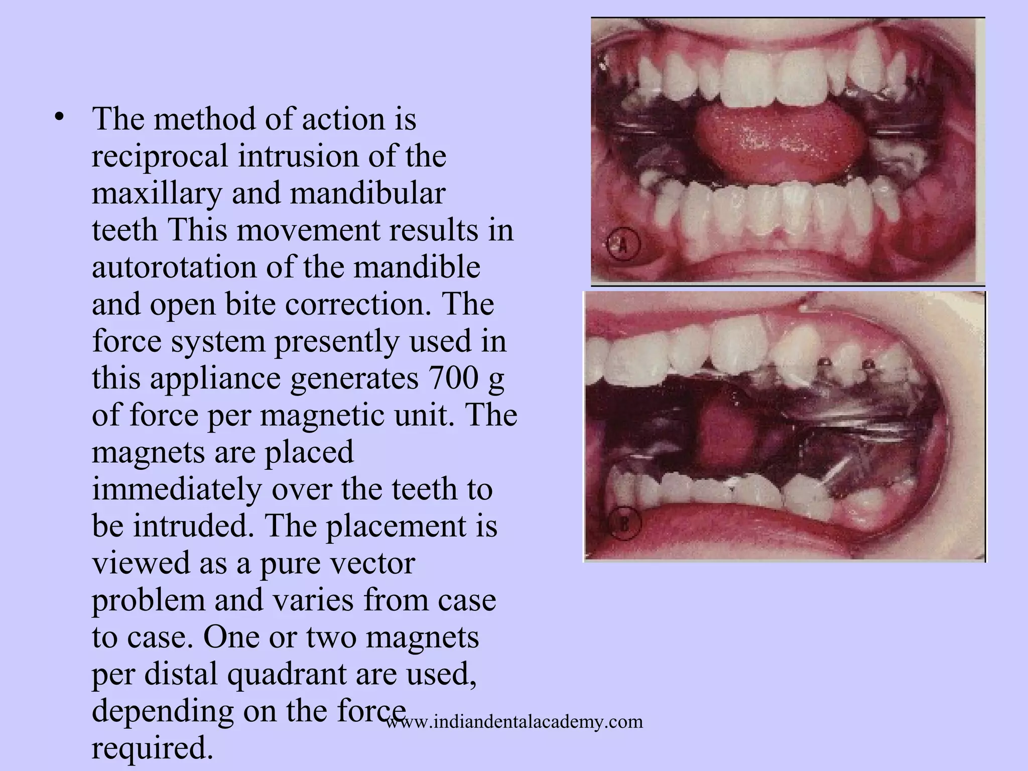 • The method of action is
reciprocal intrusion of the
maxillary and mandibular
teeth This movement results in
autorotation of the mandible
and open bite correction. The
force system presently used in
this appliance generates 700 g
of force per magnetic unit. The
magnets are placed
immediately over the teeth to
be intruded. The placement is
viewed as a pure vector
problem and varies from case
to case. One or two magnets
per distal quadrant are used,
depending on the force
www.indiandentalacademy.com
required.

 