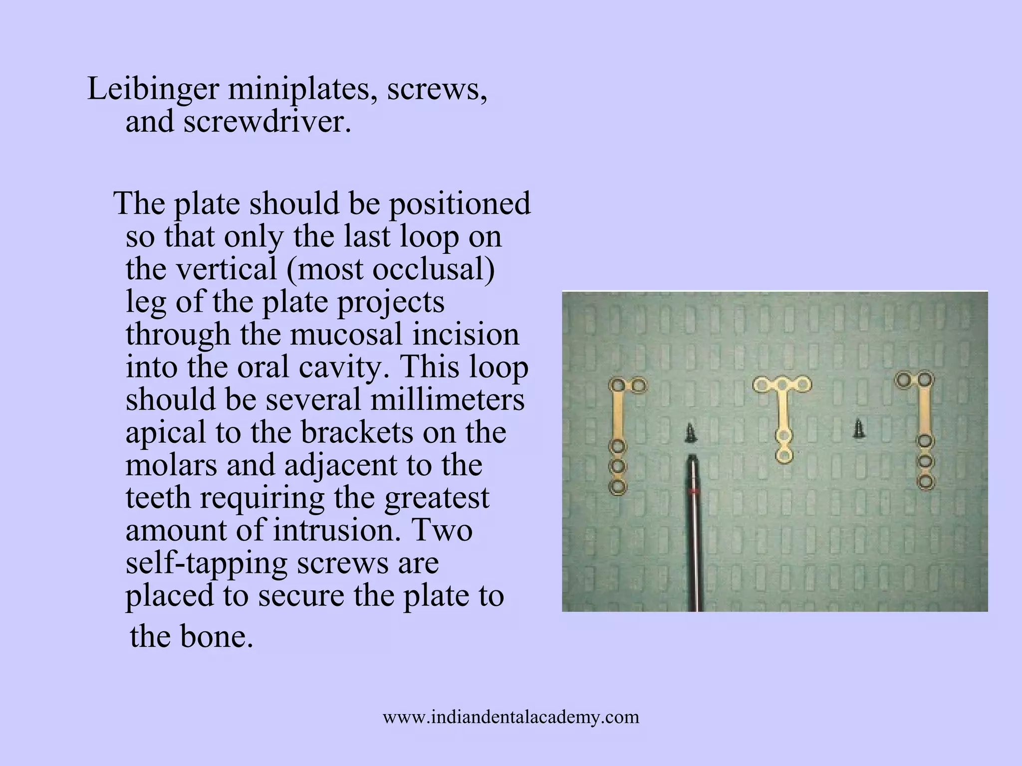 Leibinger miniplates, screws,
and screwdriver.
The plate should be positioned
so that only the last loop on
the vertical (most occlusal)
leg of the plate projects
through the mucosal incision
into the oral cavity. This loop
should be several millimeters
apical to the brackets on the
molars and adjacent to the
teeth requiring the greatest
amount of intrusion. Two
self-tapping screws are
placed to secure the plate to
the bone.
www.indiandentalacademy.com

 