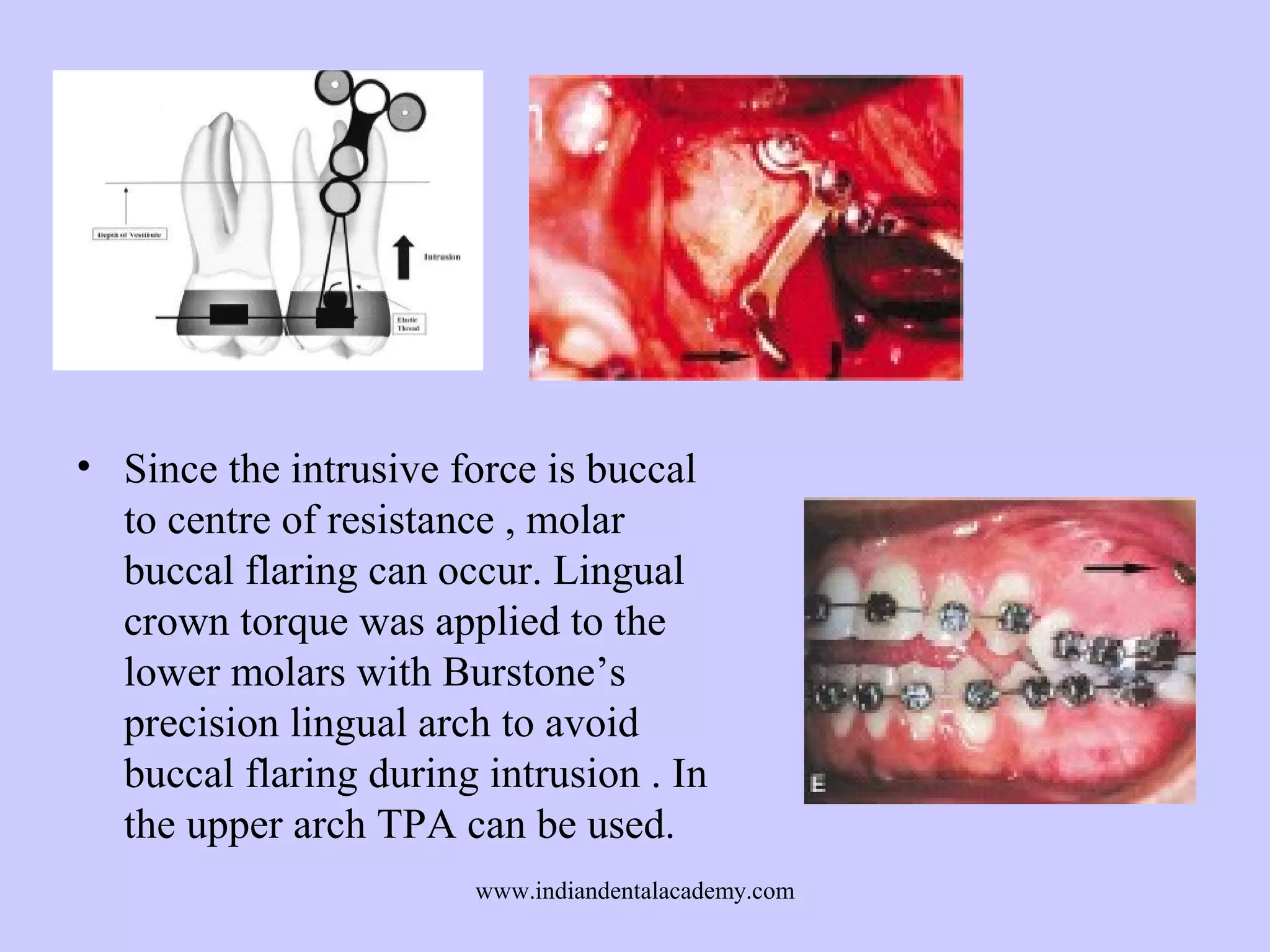• Since the intrusive force is buccal
to centre of resistance , molar
buccal flaring can occur. Lingual
crown torque was applied to the
lower molars with Burstone’s
precision lingual arch to avoid
buccal flaring during intrusion . In
the upper arch TPA can be used.
www.indiandentalacademy.com

 