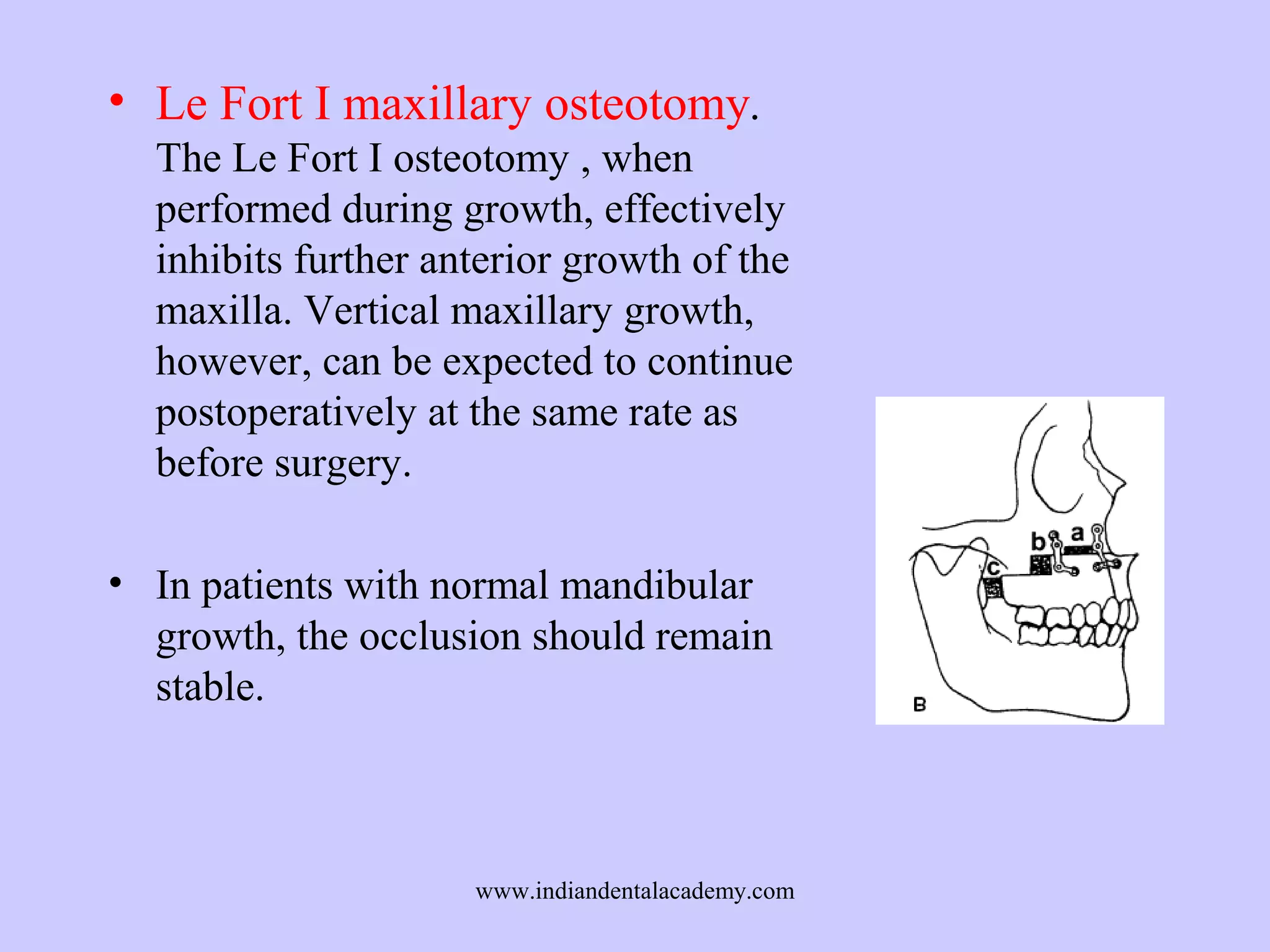• Le Fort I maxillary osteotomy.
The Le Fort I osteotomy , when
performed during growth, effectively
inhibits further anterior growth of the
maxilla. Vertical maxillary growth,
however, can be expected to continue
postoperatively at the same rate as
before surgery.
• In patients with normal mandibular
growth, the occlusion should remain
stable.

www.indiandentalacademy.com

 