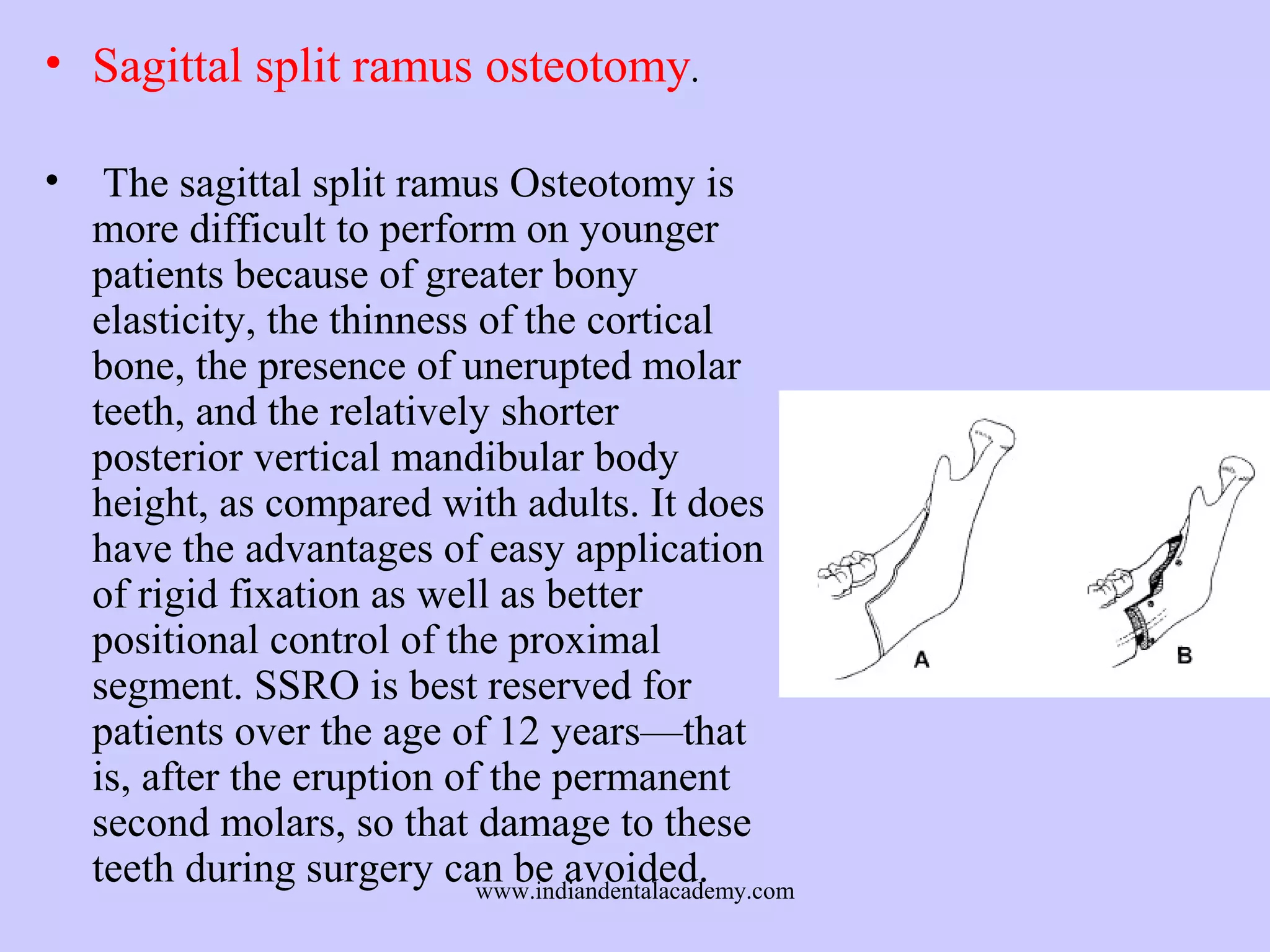 • Sagittal split ramus osteotomy.
•

The sagittal split ramus Osteotomy is
more difficult to perform on younger
patients because of greater bony
elasticity, the thinness of the cortical
bone, the presence of unerupted molar
teeth, and the relatively shorter
posterior vertical mandibular body
height, as compared with adults. It does
have the advantages of easy application
of rigid fixation as well as better
positional control of the proximal
segment. SSRO is best reserved for
patients over the age of 12 years—that
is, after the eruption of the permanent
second molars, so that damage to these
teeth during surgery can be avoided.
www.indiandentalacademy.com

 