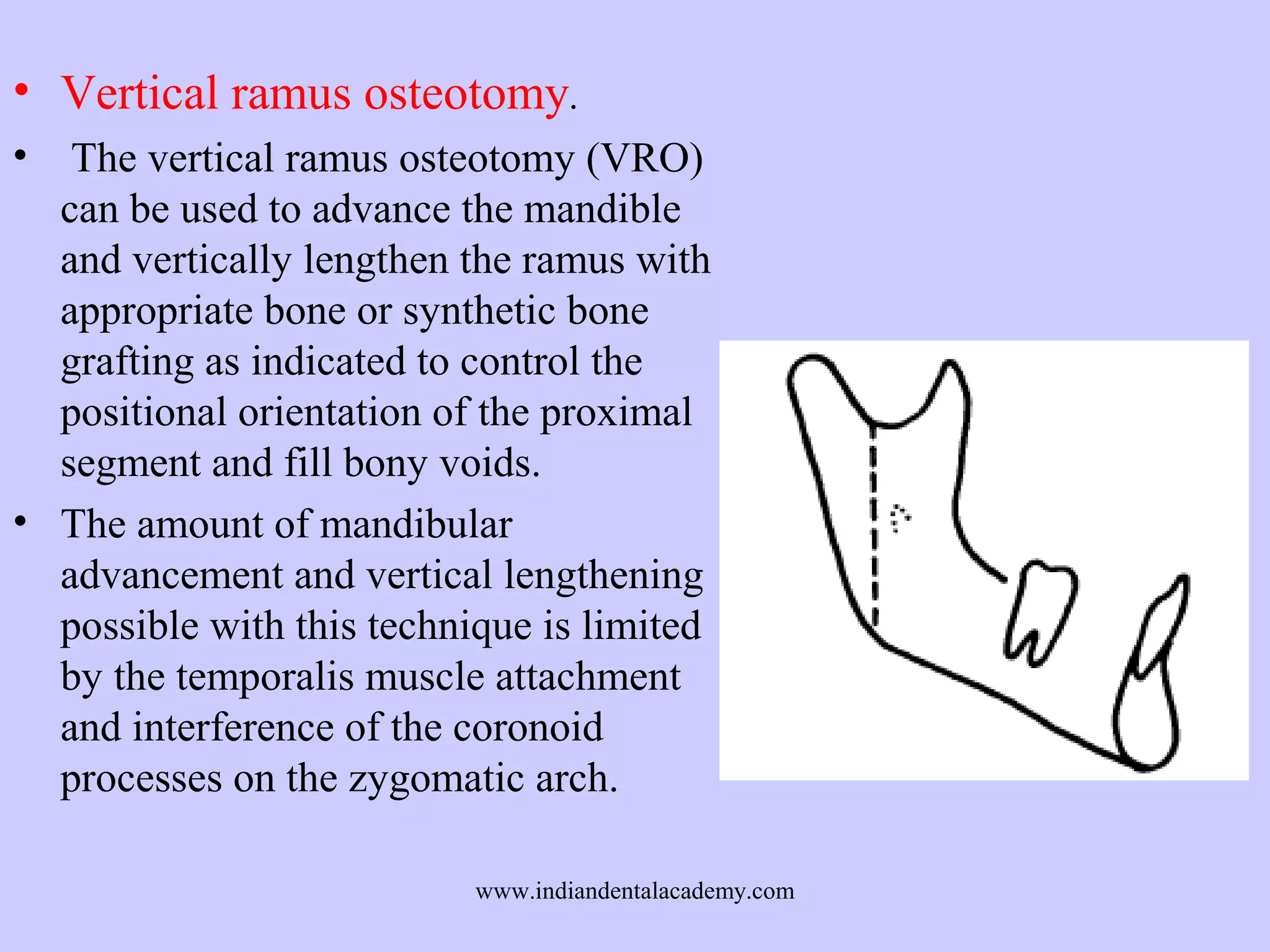 • Vertical ramus osteotomy.
•

The vertical ramus osteotomy (VRO)
can be used to advance the mandible
and vertically lengthen the ramus with
appropriate bone or synthetic bone
grafting as indicated to control the
positional orientation of the proximal
segment and fill bony voids.
• The amount of mandibular
advancement and vertical lengthening
possible with this technique is limited
by the temporalis muscle attachment
and interference of the coronoid
processes on the zygomatic arch.
www.indiandentalacademy.com

 