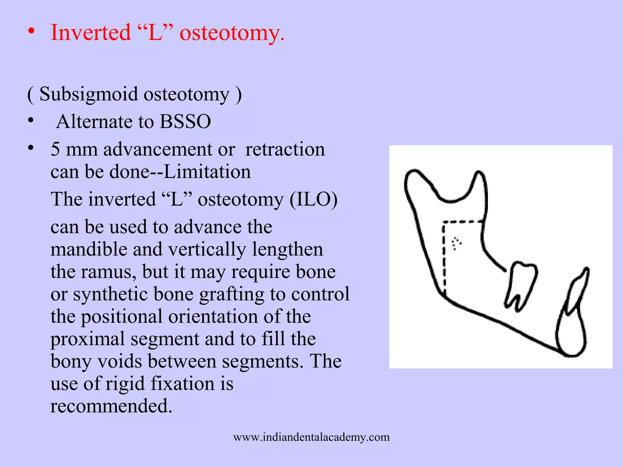 • Inverted “L” osteotomy.
( Subsigmoid osteotomy )
• Alternate to BSSO
• 5 mm advancement or retraction
can be done--Limitation
The inverted “L” osteotomy (ILO)
can be used to advance the
mandible and vertically lengthen
the ramus, but it may require bone
or synthetic bone grafting to control
the positional orientation of the
proximal segment and to fill the
bony voids between segments. The
use of rigid fixation is
recommended.
www.indiandentalacademy.com

 