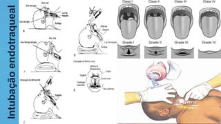 Intubaçãoendotraqueal
 