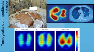 Tomografiadeimpedância
elétrica
 
