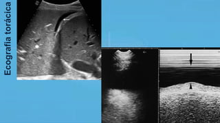 Ecografiatorácica
 