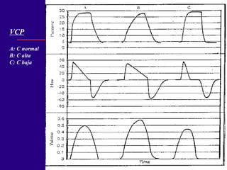 VCP A: C normal B: C alta C: C baja 