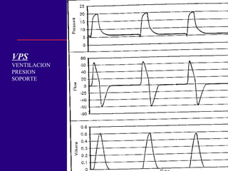 VPS VENTILACION  PRESION SOPORTE 
