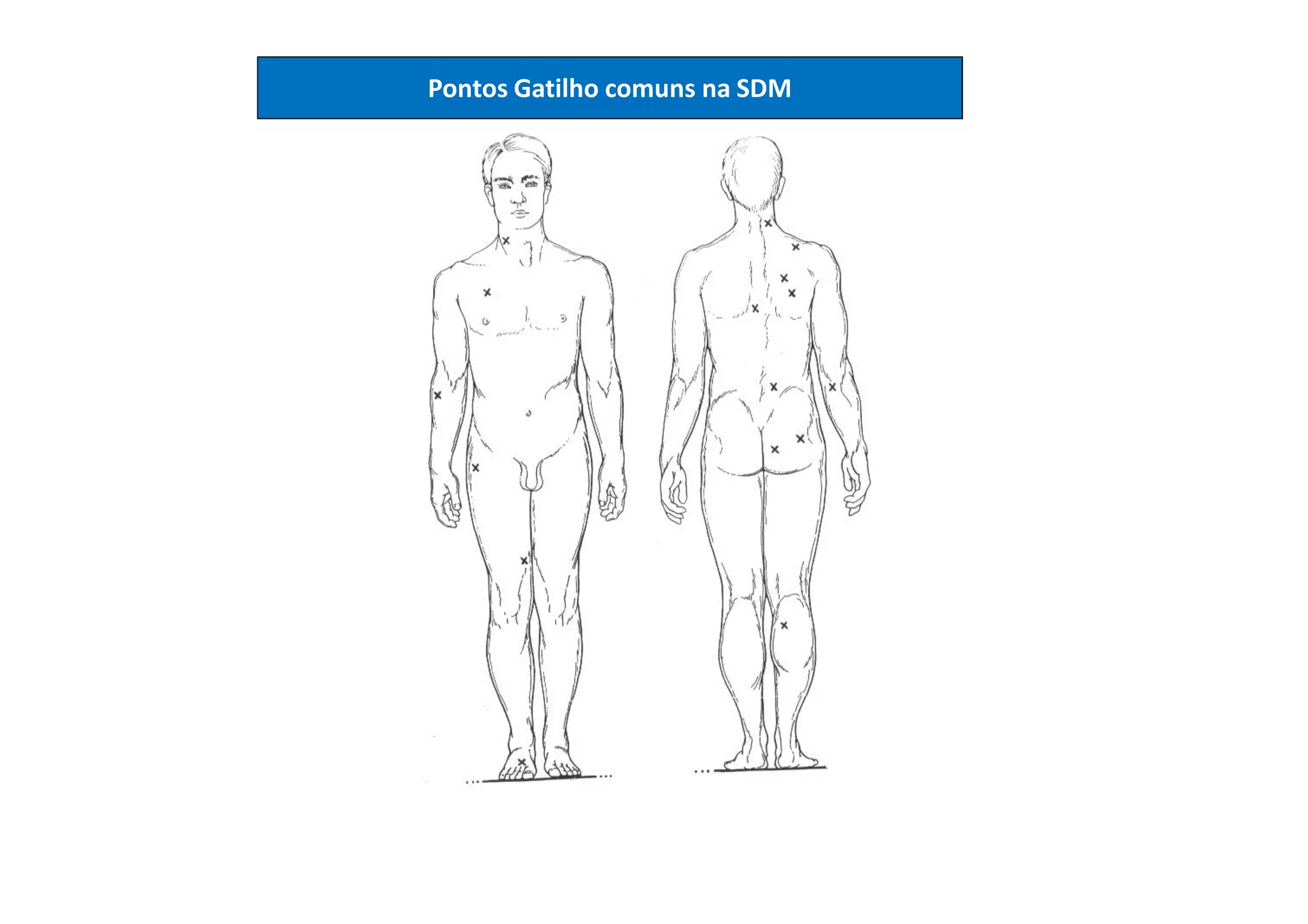 Pontos Gatilho comuns na SDM
 