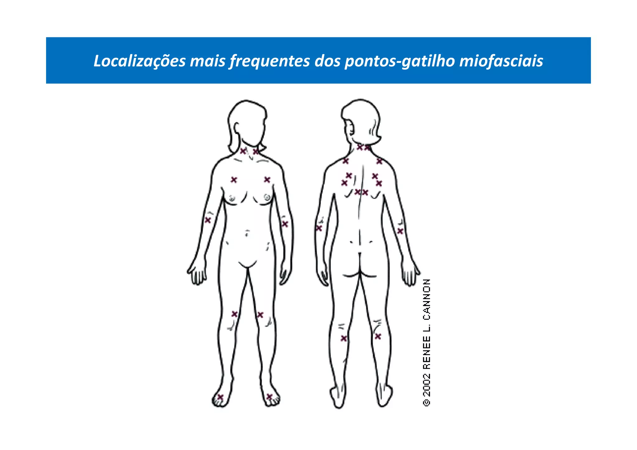 Localizações mais frequentes dos pontos-gatilho miofasciais
 