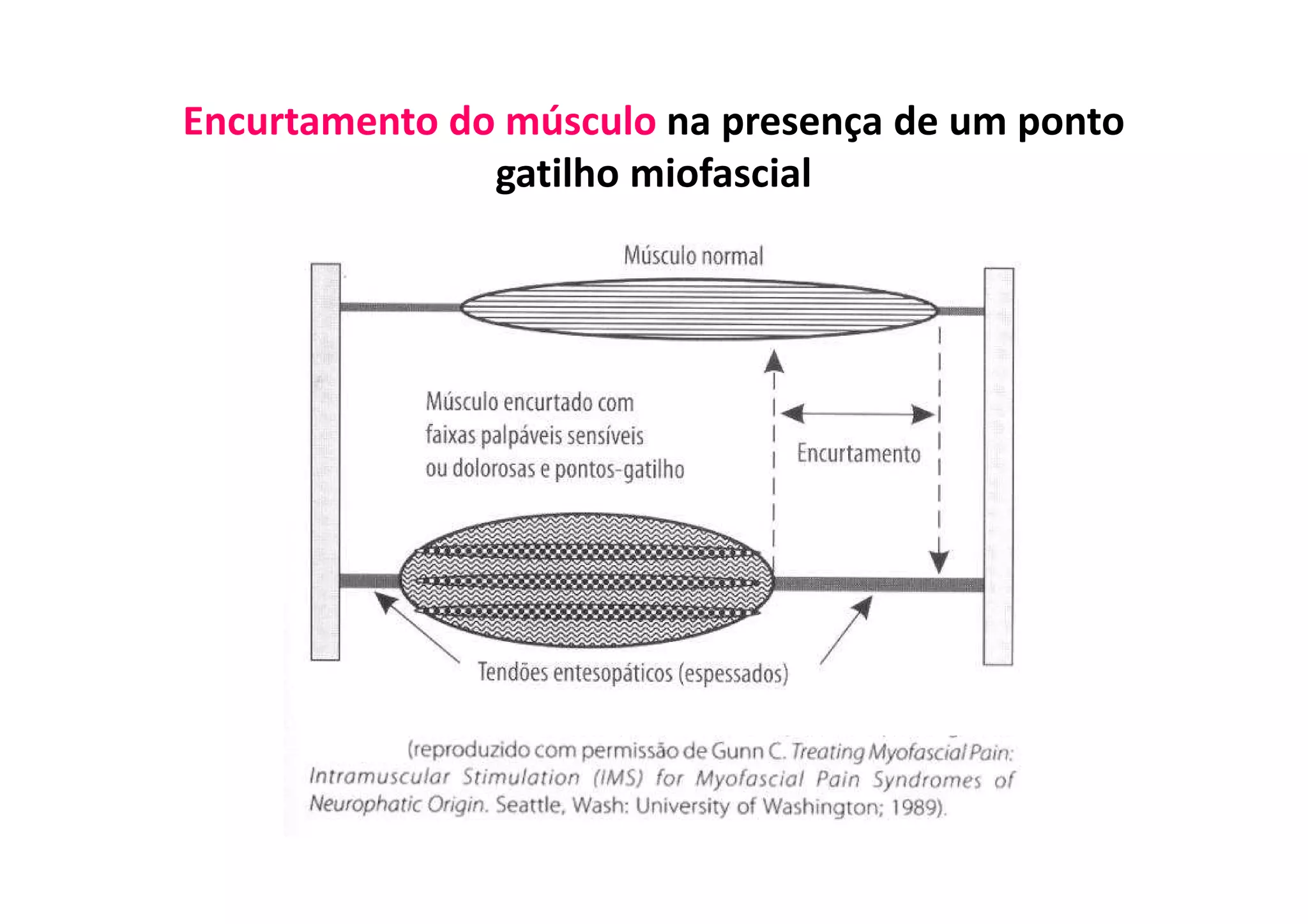 Encurtamento do músculo na presença de um ponto
gatilho miofascial
 