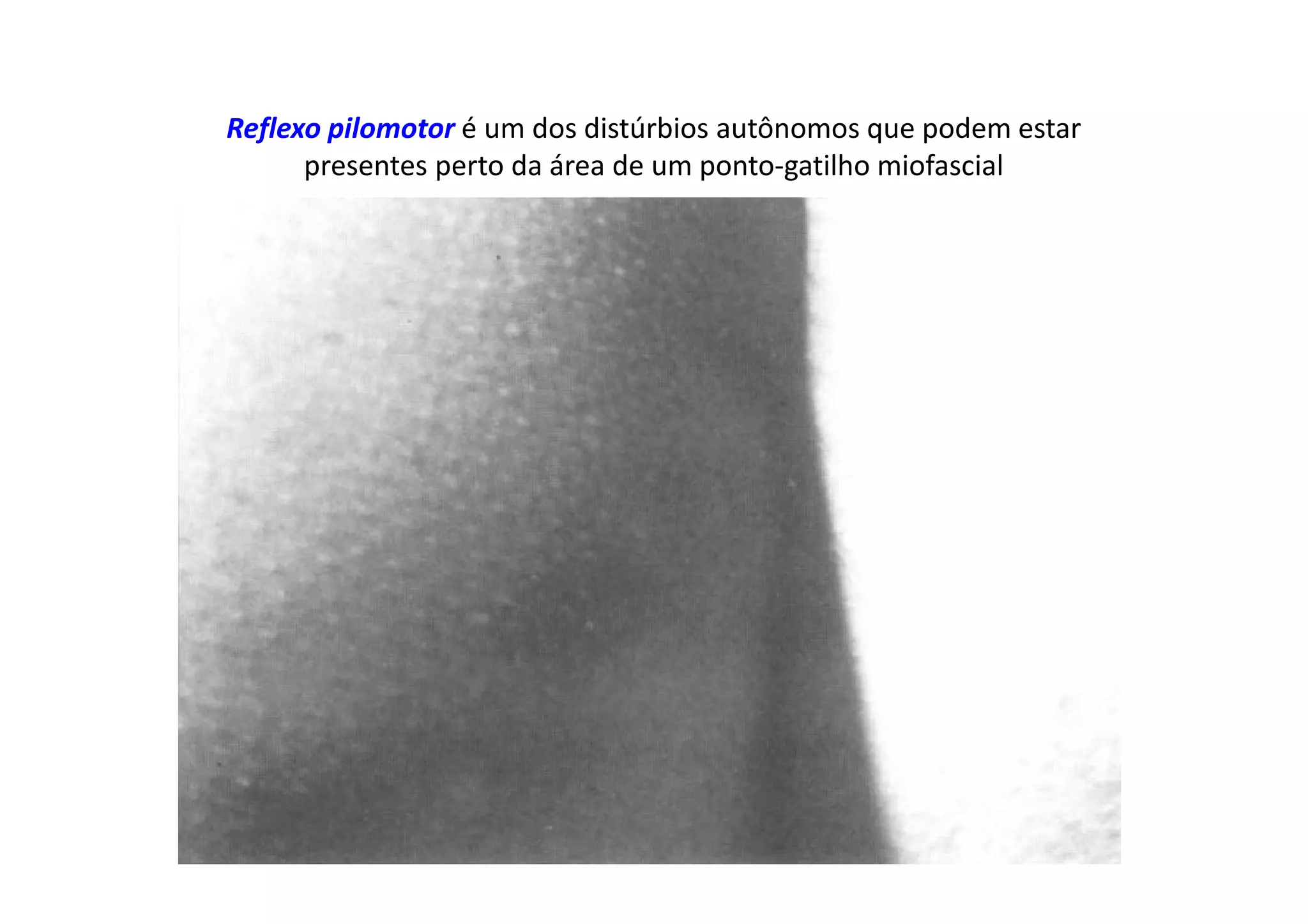 Reflexo pilomotor é um dos distúrbios autônomos que podem estar
presentes perto da área de um ponto-gatilho miofascial
 