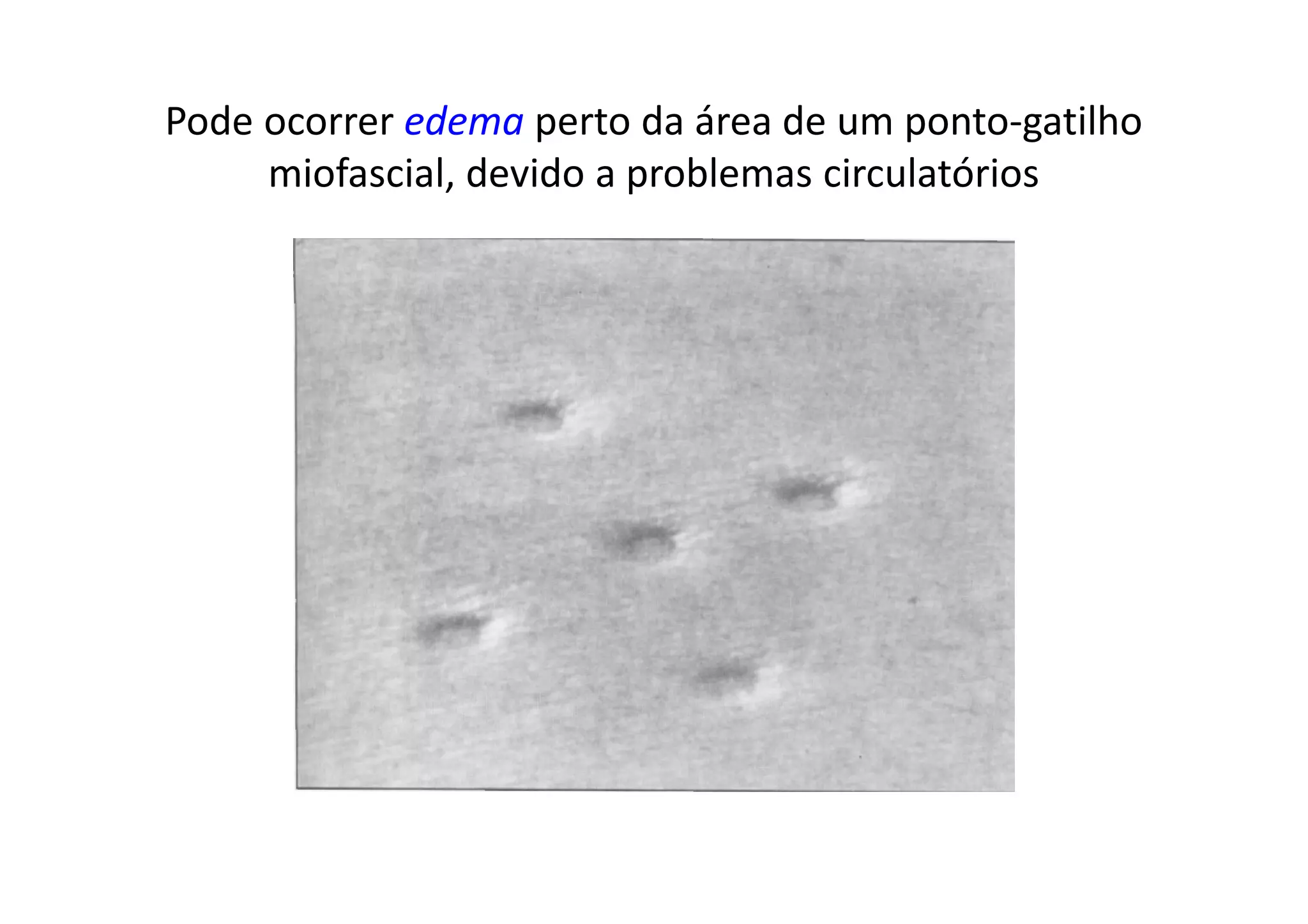Pode ocorrer edema perto da área de um ponto-gatilho
miofascial, devido a problemas circulatórios
 