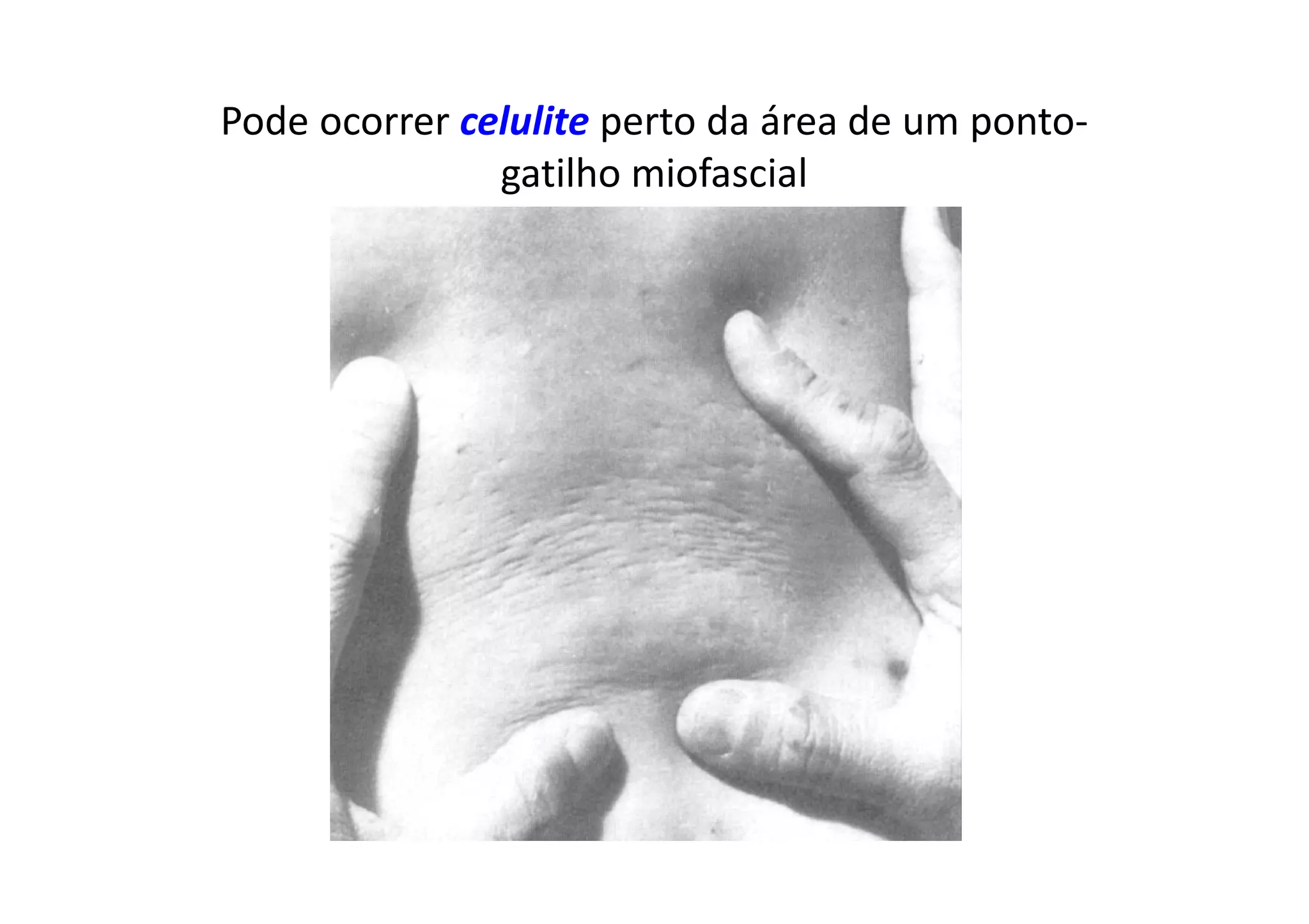 Pode ocorrer celulite perto da área de um ponto-
gatilho miofascial
 