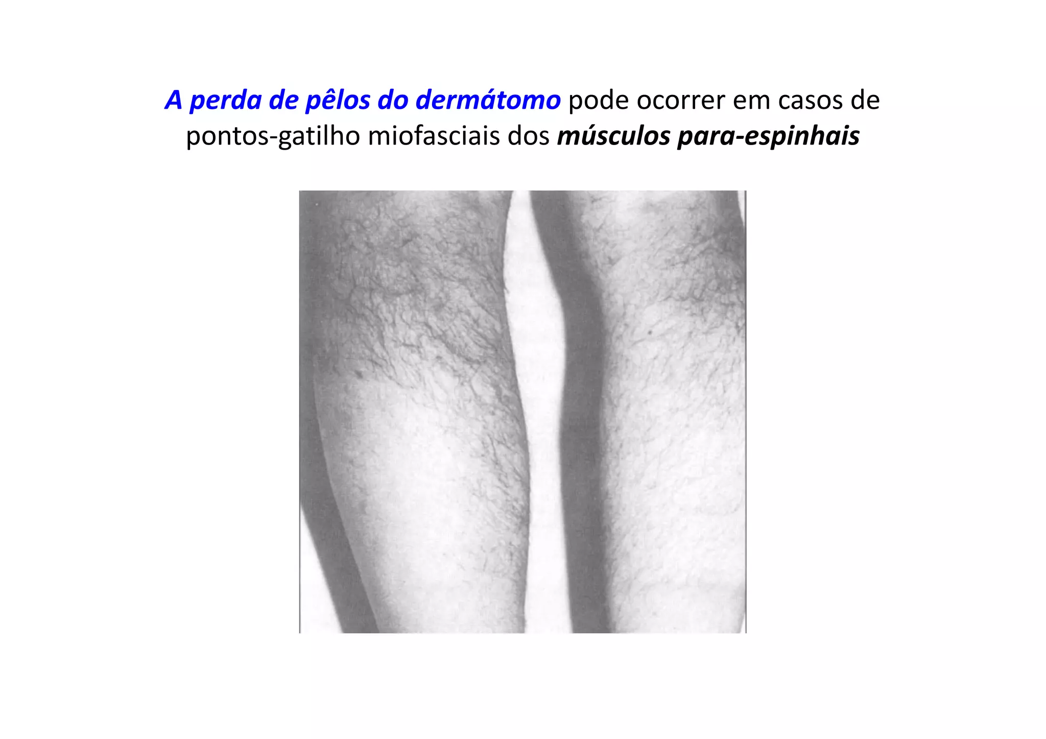 A perda de pêlos do dermátomo pode ocorrer em casos de
pontos-gatilho miofasciais dos músculos para-espinhais
 