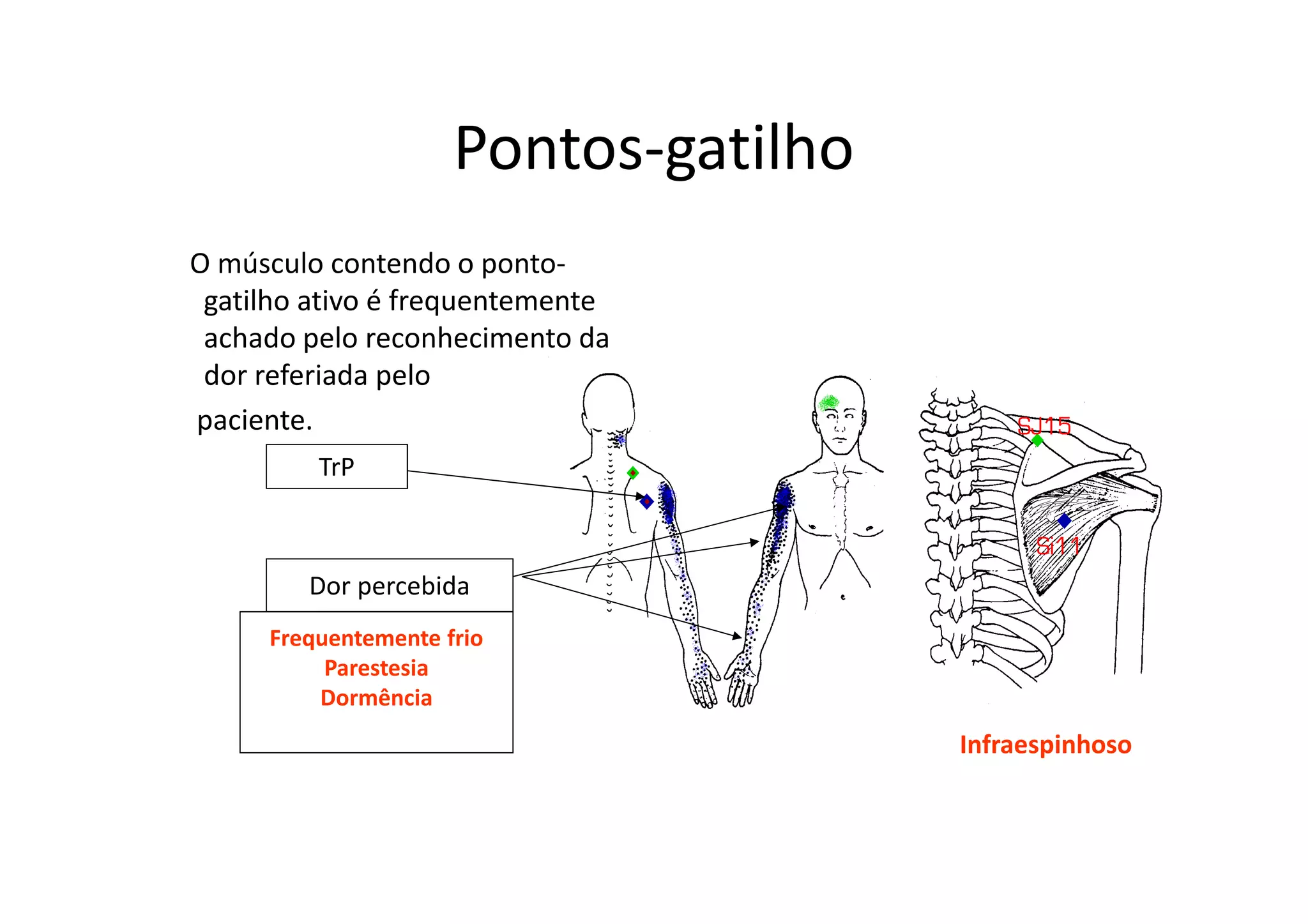 Pontos-gatilho
O músculo contendo o ponto-
gatilho ativo é frequentemente
achado pelo reconhecimento da
dor referiada pelo
paciente.
TrP
Dor percebida
Frequentemente frio
Parestesia
Dormência
Infraespinhoso
 