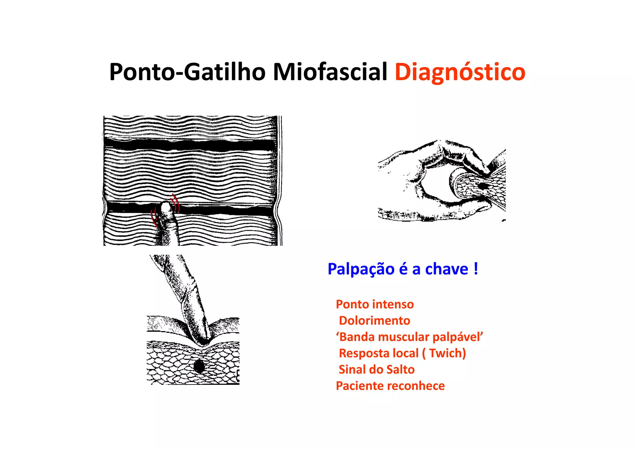 Ponto-Gatilho Miofascial Diagnóstico
Palpação é a chave !
Ponto intenso
Dolorimento
‘Banda muscular palpável’
Resposta local ( Twich)
Sinal do Salto
Paciente reconhece
 