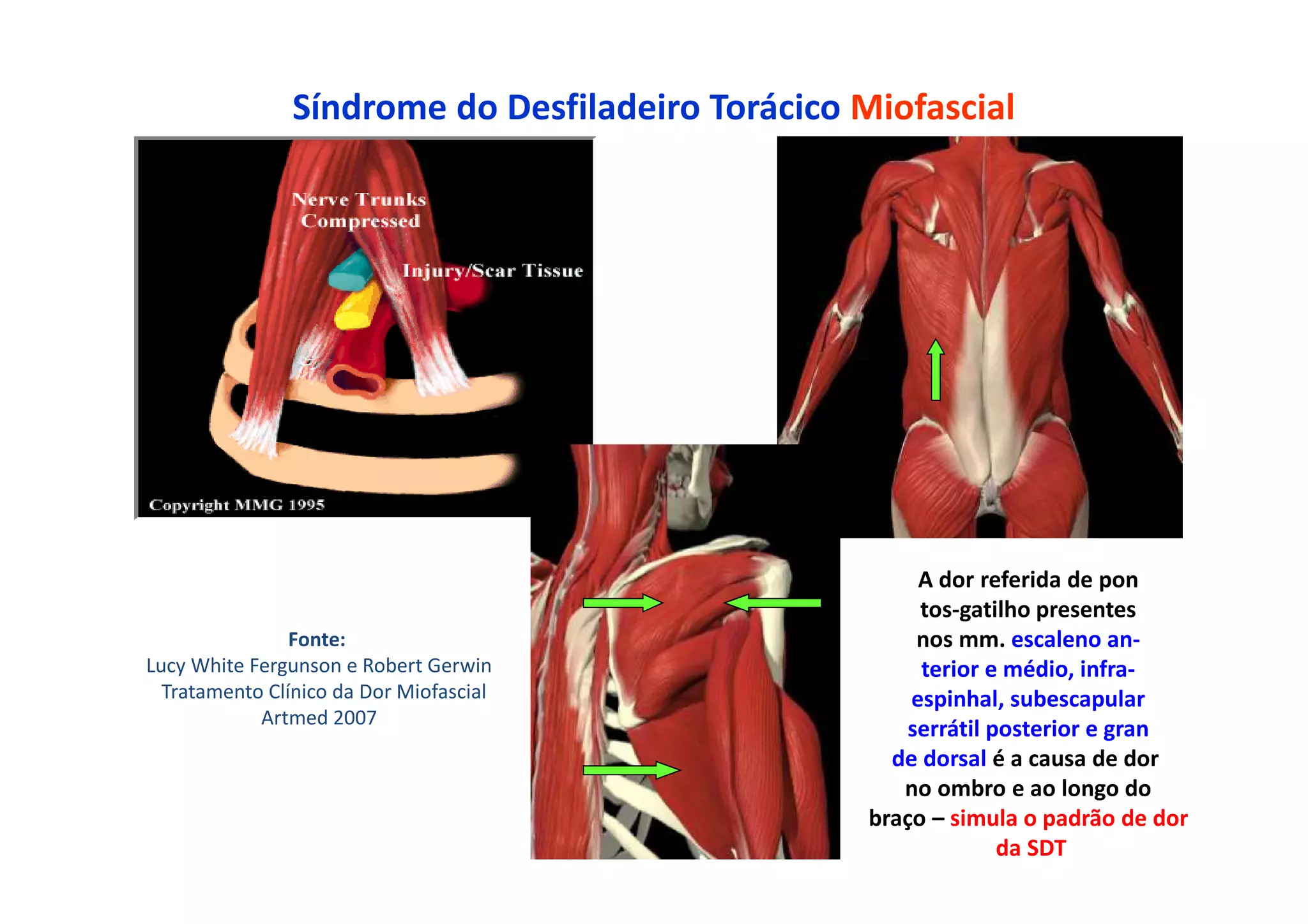 Síndrome do Desfiladeiro Torácico Miofascial
A dor referida de pon
tos-gatilho presentes
nos mm. escaleno an-
terior e médio, infra-
espinhal, subescapular
serrátil posterior e gran
de dorsal é a causa de dor
no ombro e ao longo do
braço – simula o padrão de dor
da SDT
Fonte:
Lucy White Fergunson e Robert Gerwin
Tratamento Clínico da Dor Miofascial
Artmed 2007
 