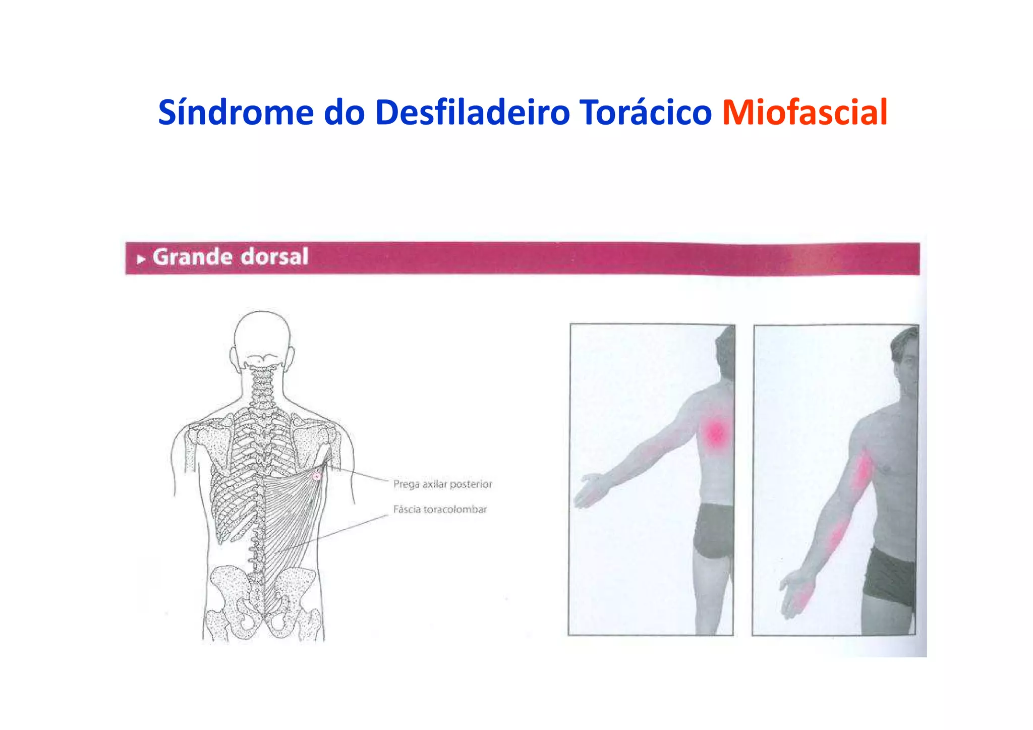 Síndrome do Desfiladeiro Torácico Miofascial
 