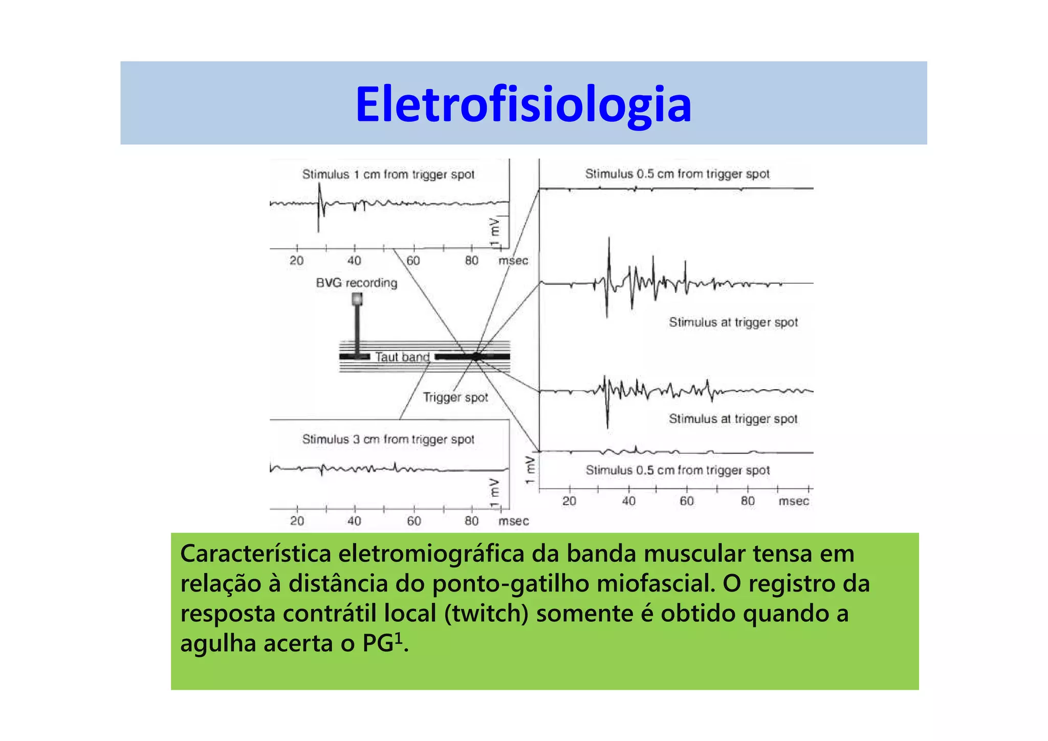 Eletrofisiologia
Característica eletromiográfica da banda muscular tensa em
relação à distância do ponto-gatilho miofascial. O registro da
resposta contrátil local (twitch) somente é obtido quando a
agulha acerta o PG1.
 
